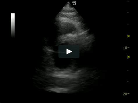 septal hypokinesis treatment.